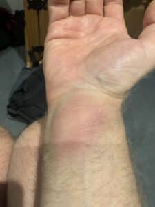 Limb knocking bruise before the use of Dit Da Jow